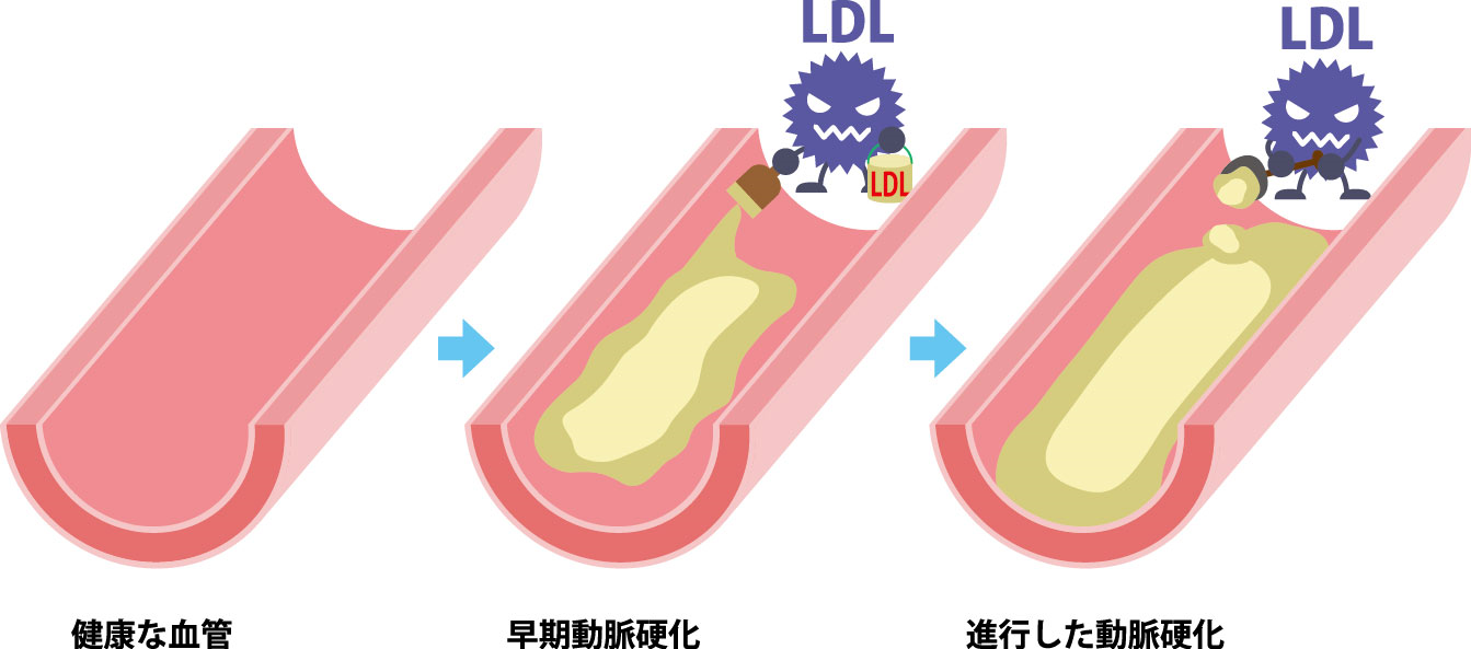 脂質異常症（高脂血症）の治療なら浅草のかわぐち内科・内視鏡クリニック